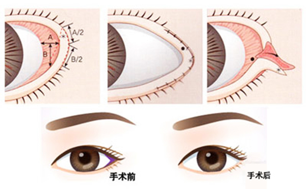 開(kāi)外眼角和眼瞼下至的區(qū)別是什么?多久恢復(fù)好?