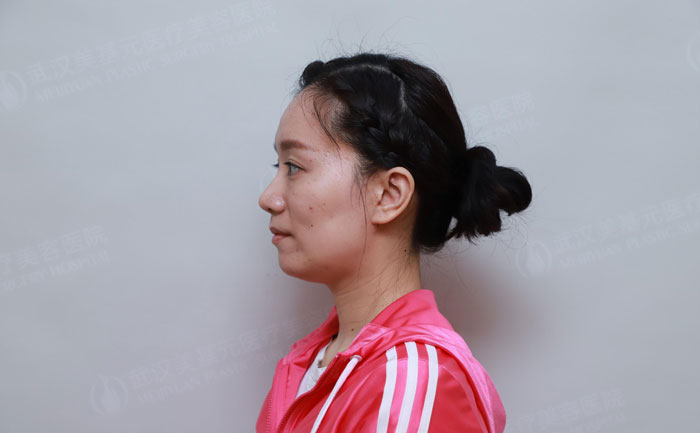 顴骨突出怎樣改善？