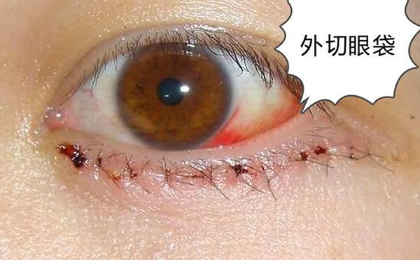 去眼袋術(shù)后出現(xiàn)眼瞼外翻是什么原因?怎么修復?