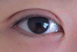 內(nèi)眥贅皮過多
