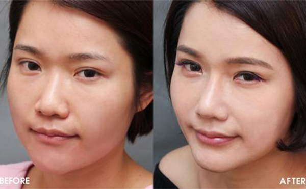 隆鼻手術(shù)怎么做效果會很好？