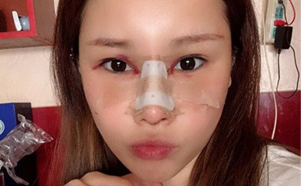 隆鼻子哪種效果好?