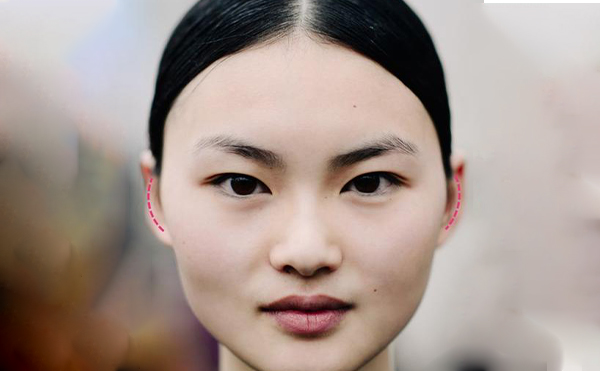 太陽(yáng)穴凹陷怎么辦?