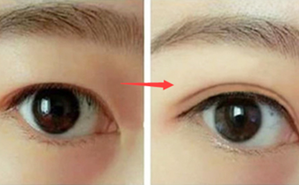 眼球突出可以做雙眼皮嗎?效果怎么樣?