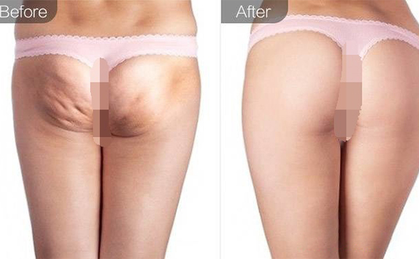 自體脂肪豐臀疼嗎?做完豐臀能躺著嗎?