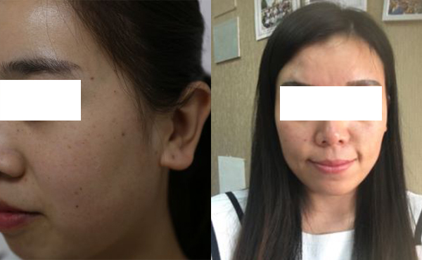 激光和光子嫩膚哪個(gè)祛斑效果好？怎么選擇？