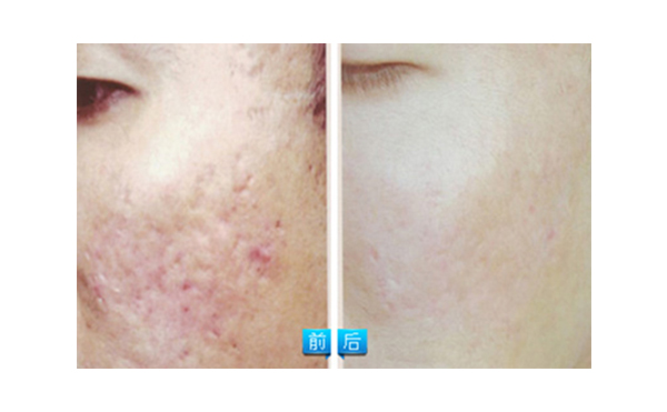 果酸煥膚多少錢？