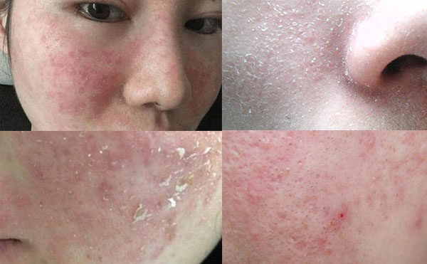 e光嫩膚有什么風(fēng)險(xiǎn)？