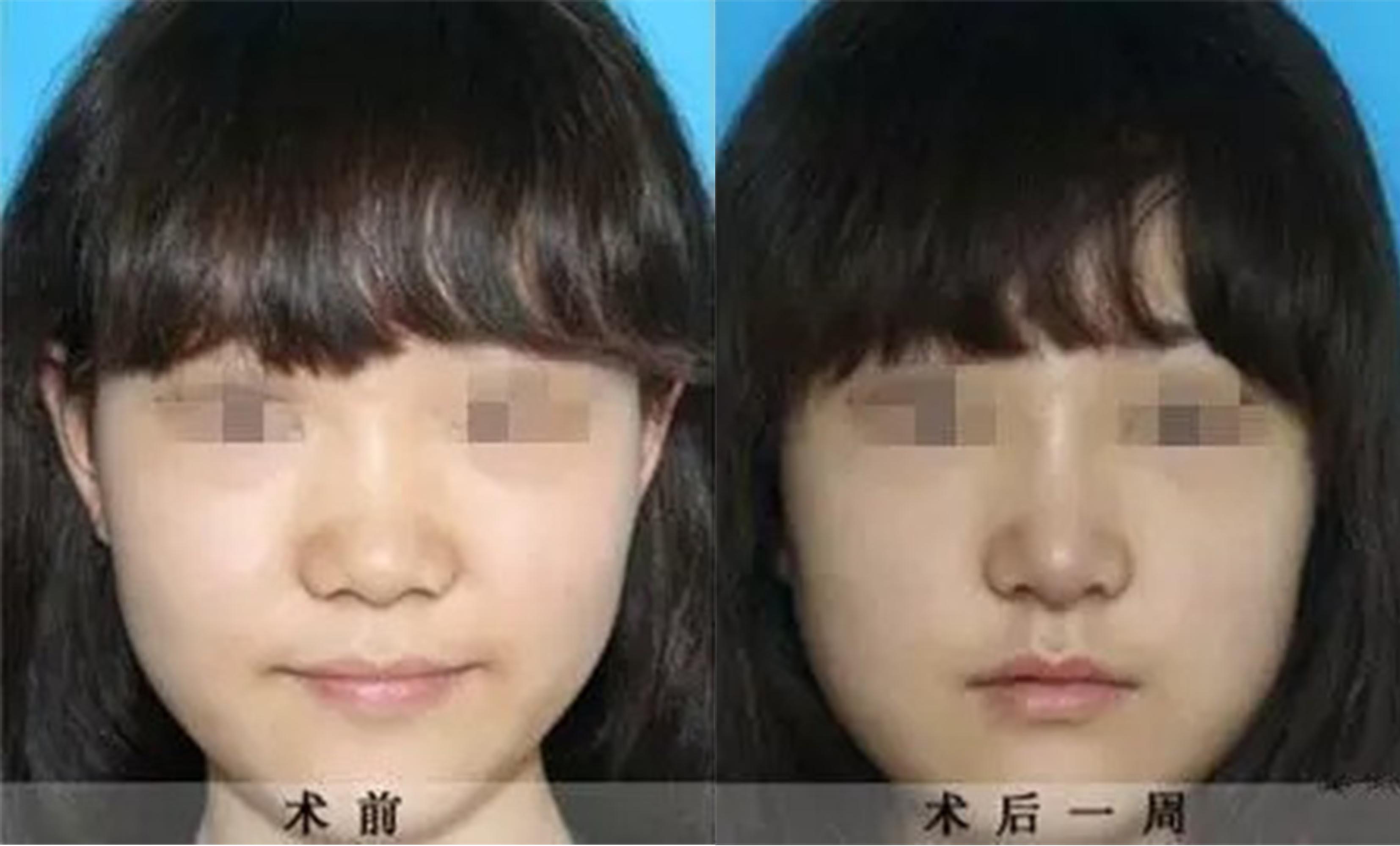 鼻頭、鼻翼縮小