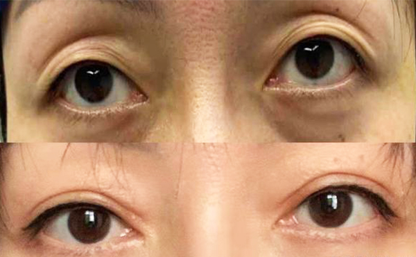 眼瞼凹陷術后有什么并發(fā)癥?有什么注意事項?