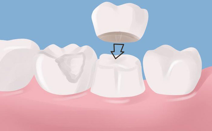 牙冠修復(fù)后能堅(jiān)持幾年？
