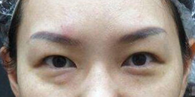 激光祛眼袋術(shù)前