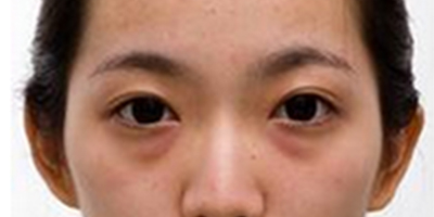 激光去黑眼圈術(shù)前