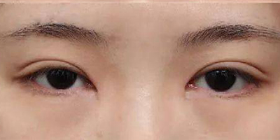 內(nèi)眥贅皮矯正術(shù)后