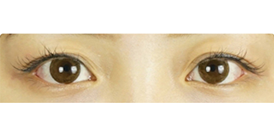 切開雙眼皮術前