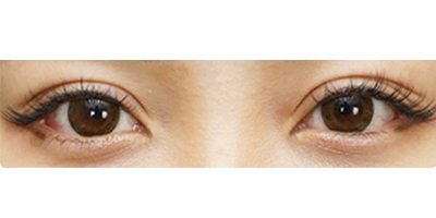 切開雙眼皮術后