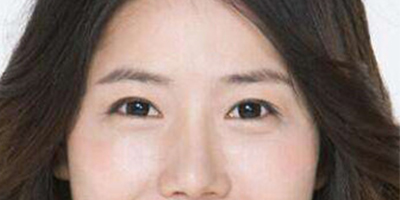 光纖溶脂祛眼袋術(shù)后