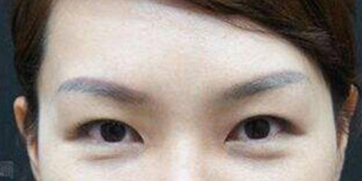 激光祛眼袋術(shù)后