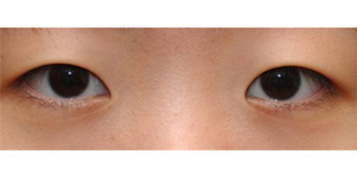 開(kāi)內(nèi)眼角術(shù)前