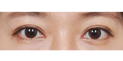 定點(diǎn)雙眼皮術(shù)后