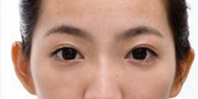 激光去黑眼圈術(shù)后