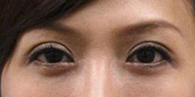 玻尿酸去黑眼圈術(shù)后