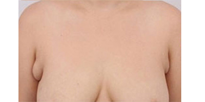 吸脂去副乳術(shù)前