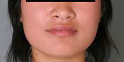 取頰脂墊瘦臉術前