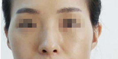 玻尿酸豐太陽(yáng)穴術(shù)前