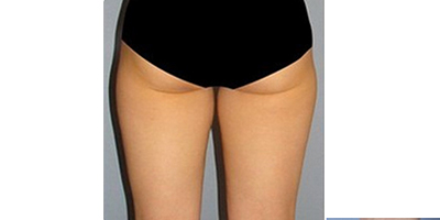 臀部吸脂術(shù)前