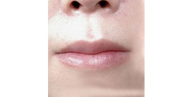 人中縮短術(shù)術(shù)前