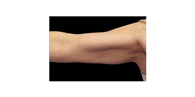 冷凍溶脂瘦手臂術(shù)后