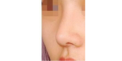 駝峰鼻矯正術后