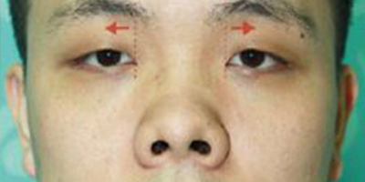 鼻孔矯正術(shù)前