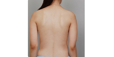 動(dòng)氧瘦腰部術(shù)前