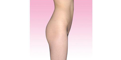 自體脂肪豐臀術(shù)前