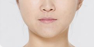 光纖溶脂瘦臉術(shù)前