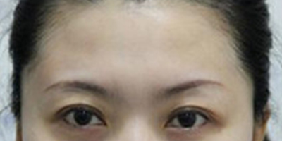 自體脂肪豐太陽(yáng)穴術(shù)后