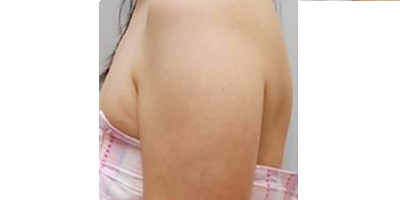 超聲溶脂瘦手臂術前