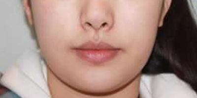 下巴吸脂術(shù)/去雙下巴術(shù)前