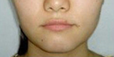 玻尿酸豐面頰術(shù)前
