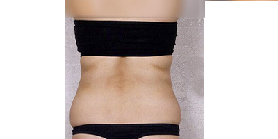 隔空溶脂瘦背部術(shù)前