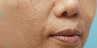 玻尿酸去法令紋術(shù)前