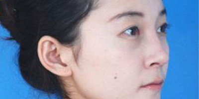 曼特波隆鼻術后