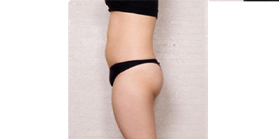 冷凍溶脂瘦大腿術(shù)前