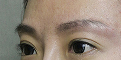 玻尿酸豐眉弓術后