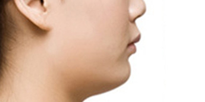 下巴截骨術術前