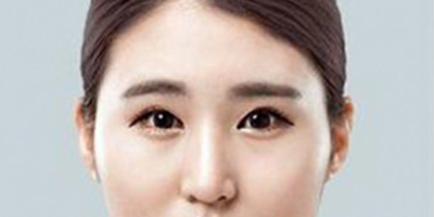 顴骨顴弓整形術(shù)術(shù)前