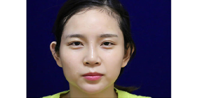 膠原蛋白隆鼻術(shù)后