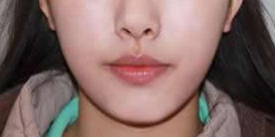 下巴吸脂術(shù)/去雙下巴術(shù)后